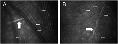 Altered Corneal Innervation and Ocular Surface Homeostasis in FHV-1-Exposed Cats: A Preliminary Study Suggesting Metaherpetic Disease